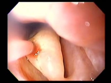 Severe Epistaxis - Case Study  (2 of 8)