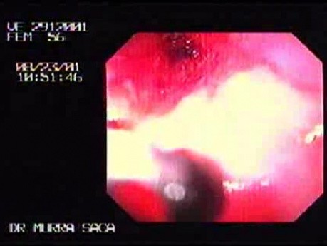 Reflux Esophagitis & Esophageal Stricture - Biopsy