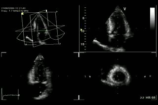 Left Ventricular Ejection Fraction (LVEF)