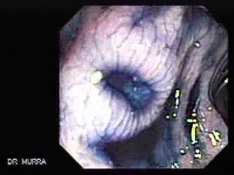 Colonoscopic Polypectomy (7 of 23)