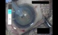 Cataract Surgery 2 - Part 1