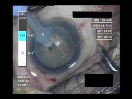 Cataract Surgery 2 - Part 1