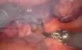 Para Aortic Lymph Node Dissection
