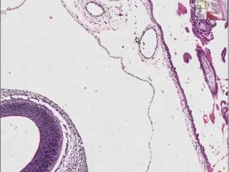 Ectopic pregnancy with embryo