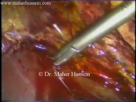 Duct of Lushka - Laparoscopic Ligation