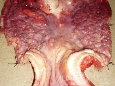 Endoscopy of Scirrhous Gastric Carcinoma involving the entire Fundus, Body and the Antrum (28 of 47)