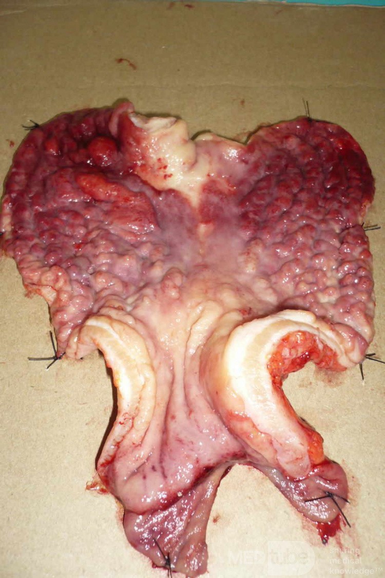 Endoscopy of Scirrhous Gastric Carcinoma involving the entire Fundus, Body and the Antrum (28 of 47)