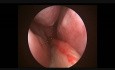 Epipharynx Carcinoma With Serous Otitis Media