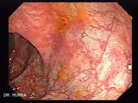 Colitis Ulcerosa - Pseudopolyps (8 of 22)