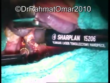 Near Total Subcapsular Tonsillotomy - Laser Technique