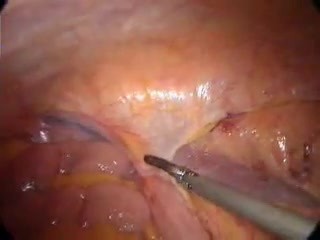 Laparoscopic right hemicolectomy
