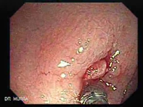 Polyp Inside Of A Diverticulum (4 of 12)