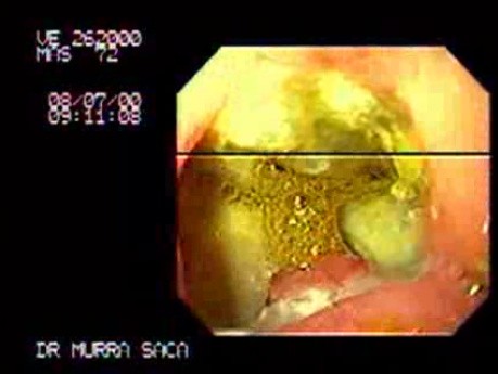 Gastric Ulcer with Fistolous Biliary Tract