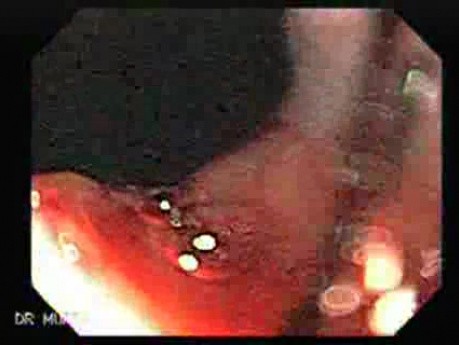 Achalasia - Assessment of Treatment Result (After Dilatation with Balloon)