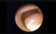 Endometrail Polips with Biopsy