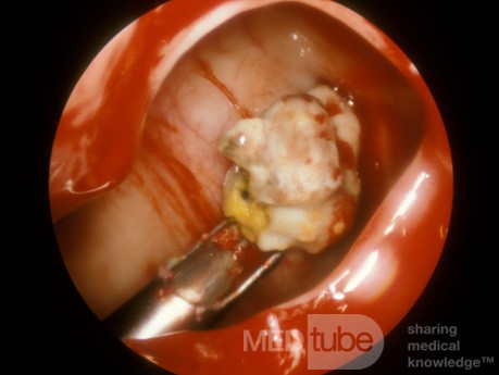 Maxillary Sinus Fungus Ball