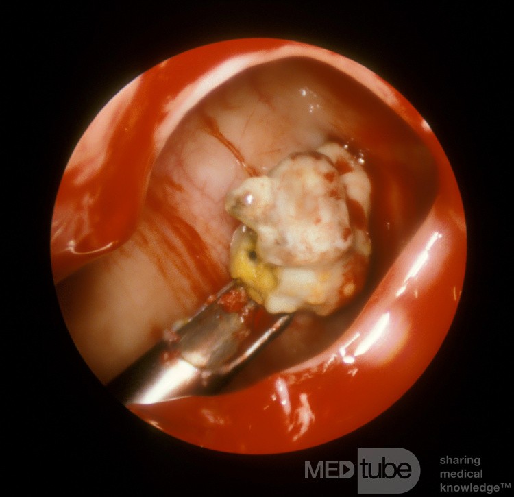 Maxillary Sinus Fungus Ball