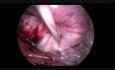Laparoscopic Large Broad Ligament Myomectomy