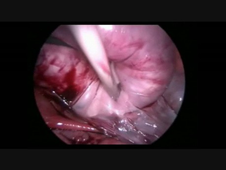 Laparoscopic Large Broad Ligament Myomectomy