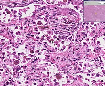 Organizing Pneumonia