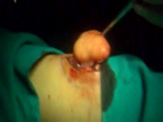 Surgery Of A Lipoma On The Forearm