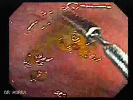 Acute Diverticulitis (5 of 5)