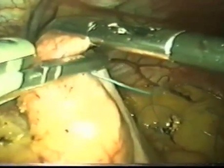 Conventional Laparoscopy to Laparo-Endoscopic Single Site Fundoplication The Journey For GERD