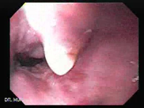 Esophageal Varix - Bleeding - 65 Years-Old Diabetic Woman