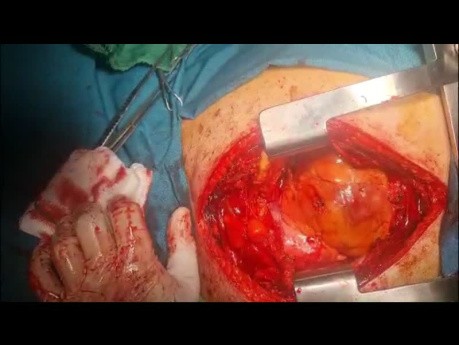Left Ventricular Size Reduction With Mesh PP and SVR and PPM Insertion 