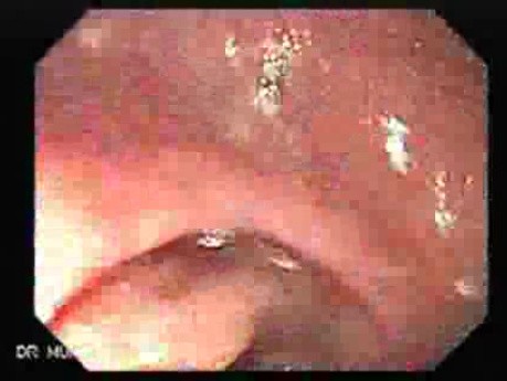 Ulcerative Colitis Complicating Colon Cancer (4 of 4)