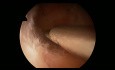 Hysteroscopic Adhesiolysis