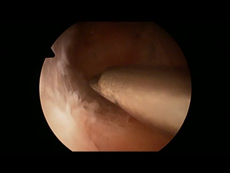 Hysteroscopic Adhesiolysis