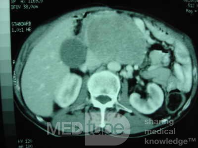 Gastric Ulcer with Gastrocolic fistula due to a Zollinger-
 Ellison Syndrome (30 of 33)