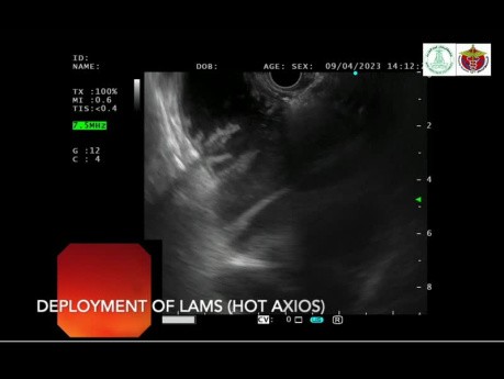 Malignant Afferent Loop Syndrome Obstruction Treated with EUS-Guided LAMS Gastrojejunostomy