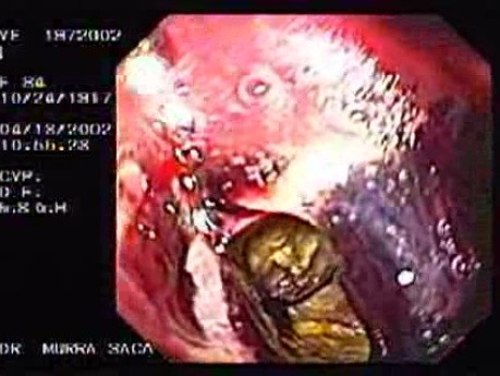 Ulcerative Adenocarcinoma of the Gasrtic Fudnus With Hemorrhage