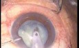 Phacoemulsification - Stop And Chop Technique - White Cataract