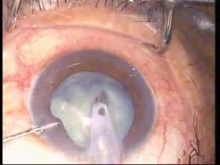 Phacoemulsification - Stop And Chop Technique - White Cataract