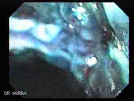 Barrett's Esophagus of long segment (14 of 24)