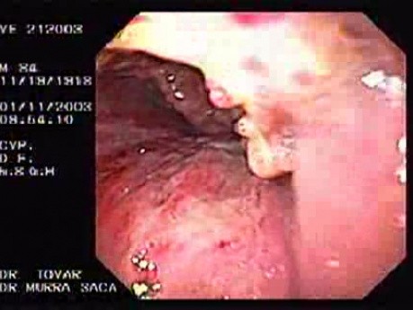 Laryngeal carcinoma invading epiglottis and tongue 2/2