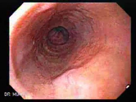 Klatskin´s Tumor - Presence of Esophageal Varices