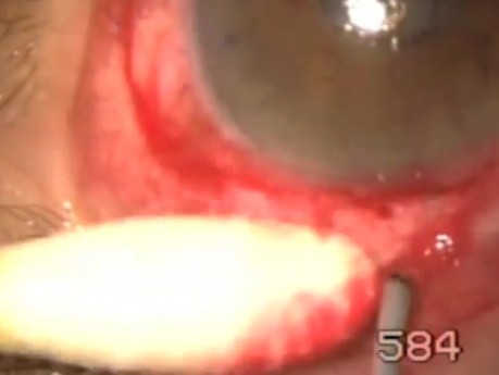 Uveitic glaucoma- transciliary filtration