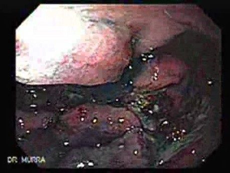 Multiple Irregular and Large Ulcers - Chromoendoscopy with Indigo Carmine Stain, Part 1