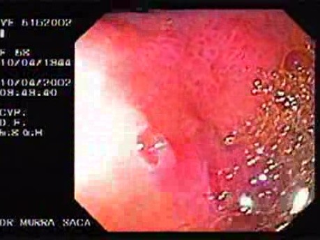 Gastric Lymphoma - Assessment of the Gastric Mucosa