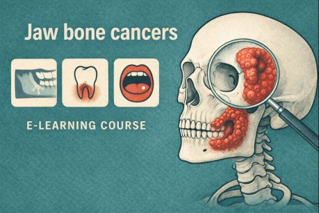 Jaw Bone Cancers