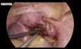 Laparoscopic Myomectomy for Posterior Wall Fibroid Uterus with Endometriosis 