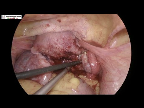 Laparoscopic Myomectomy for Posterior Wall Fibroid Uterus with Endometriosis 