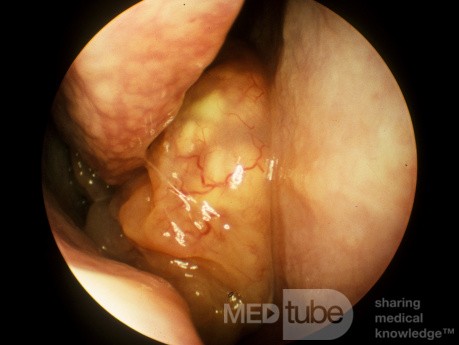 Inverting Papilloma Right Nasal Cavity A