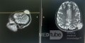 Epicranial Tumor Injury