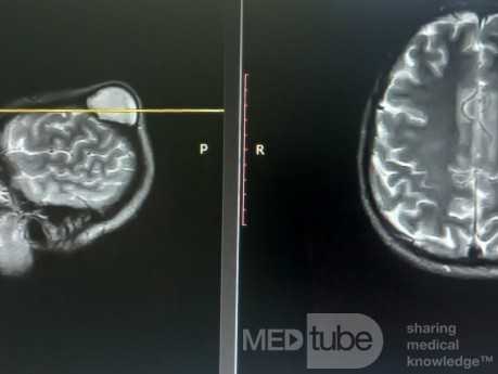 Epicranial Tumor Injury