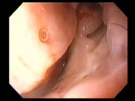 Severe Epistaxis - Case Study  (8 of 8)
